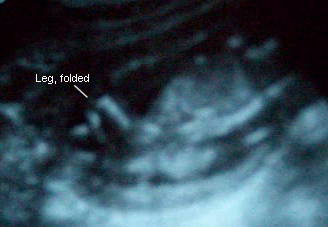 The baby's legs, folded at the knee!