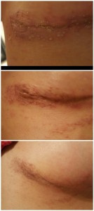 Steri-Strip Allergic Reaction - Recovery Over 6 Weeks